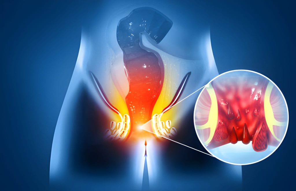 laser hemorrhoids laser hemorrhoids