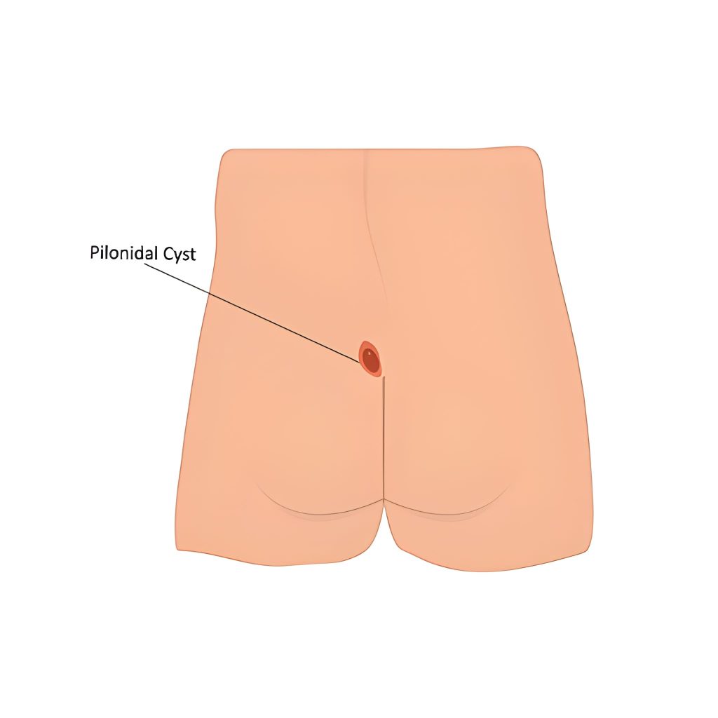 pilonidal sinus pilonidal sinus
