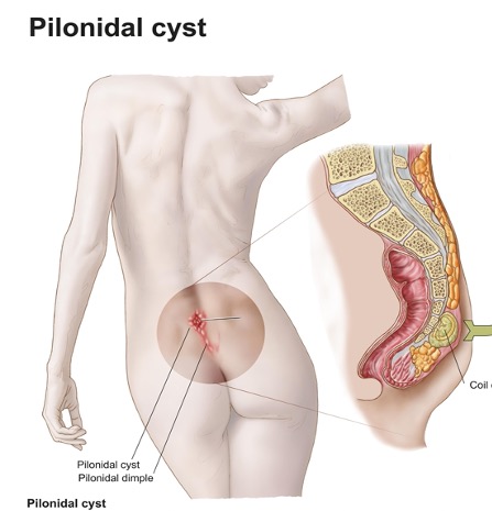 pilonidal sinus patient pilonidal sinus patient